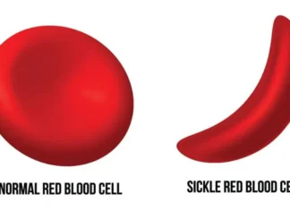 Questions And Answers About Sickle Cell Disease