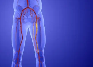 That Leg Pain May Not Be Aging. It Could Be PAD