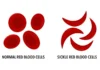 Sickle Cell Awareness Month Highlights Importance Of Understanding Disease, Trait And Treatment